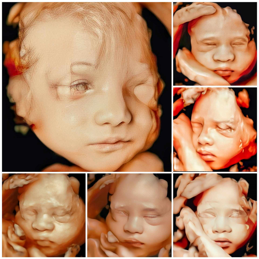 A normal image of the fetal face using AI-enhanced 3D/4D ultrasound provides a comprehensive view of the facial anatomy