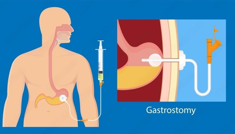 percutaneous endoscopic gastrostomy (PEG)